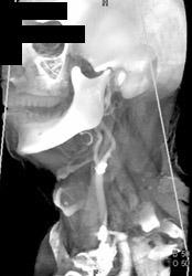 Plaque at Carotid Bifurcation - CTisus CT Scan