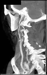 VRT Vs MIP of Carotid Artery - CTisus CT Scan