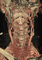 Plaque at Bifurcation of Left Carotid Artery - CTisus CT Scan