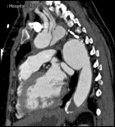 Dissection Extends Into Subclavian Artery - CTisus CT Scan