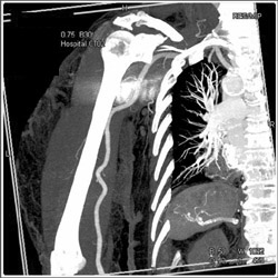 Axillary Artery - CTisus CT Scan