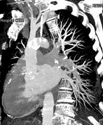 MIP of Arch and Coronary Artery - CTisus CT Scan