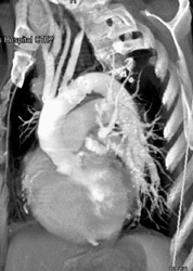 Plaque at Aortic Arch - CTisus CT Scan