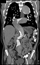 Aortic Dissection - CTisus CT Scan