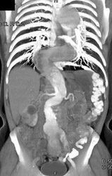 Aortic Dissection - CTisus CT Scan