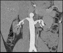 Vasculitis - CTisus CT Scan