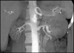 Vasculitis Involves Renal Arteries - CTisus CT Scan