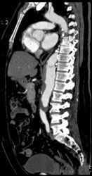 Aortic Dissection - CTisus CT Scan