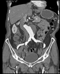 Aortic Aneurysm - CTisus CT Scan