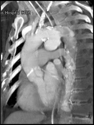 Ductus Aneurysm - CTisus CT Scan