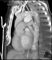 Ductus Aneurysm - CTisus CT Scan