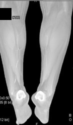 Runoff Study - CTisus CT Scan