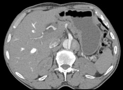 Aortic Dissection - CTisus CT Scan