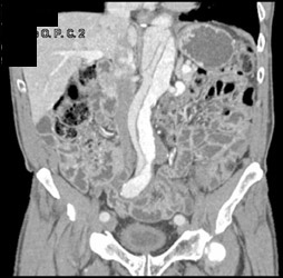 Aortic Dissection - CTisus CT Scan