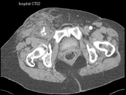 Active Bleed Following Arterial Puncture - CTisus CT Scan