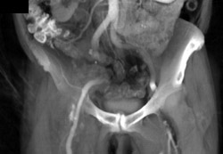 Occluded Right Common Iliac Artery - CTisus CT Scan