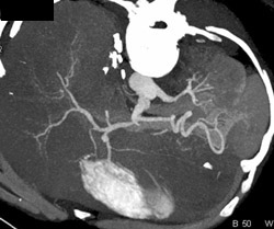 Narrowed Lumen of Abdominal Aorta - CTisus CT Scan