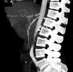 Focal Narrowing of Aorta and Origin of Celiac Artery - CTisus CT Scan