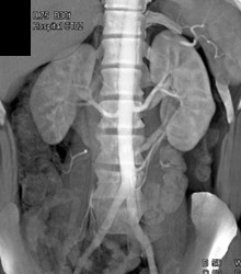 Retroaortic Renal Vein - CTisus CT Scan