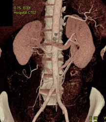 Retroaortic Renal Vein and Multiple Left Renal Arteries - CTisus CT Scan