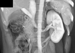 Retroaortic Left Renal Vein - CTisus CT Scan