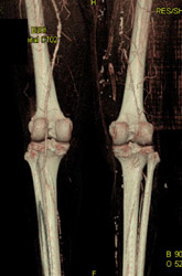 Diseased Popliteal Vessels - CTisus CT Scan