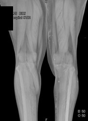 3D of Muscle With VRT - CTisus CT Scan