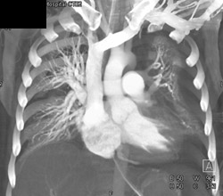 Normal Pulmonary Inflow Tract - CTisus CT Scan