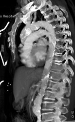 Plaque in Aorta - CTisus CT Scan