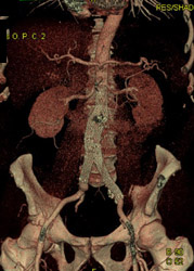 Endovascular Stent - CTisus CT Scan