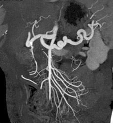 Normal Mesenteric Vasculature - CTisus CT Scan