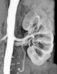 Normal VRT/MIP of Renal Artery - CTisus CT Scan