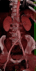 Prior Abdominal Aortic Aneurysm (AAA) Repair W/o Leak - CTisus CT Scan