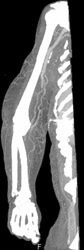 Poor Flow in Right Arm - CTisus CT Scan