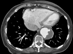 Aortic Ulceration With Hematoma in Wall of Aorta - CTisus CT Scan