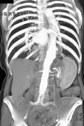 Ulcerating Plaque - CTisus CT Scan