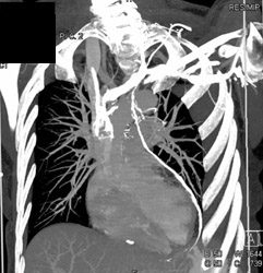 Lymph Leak Due to Cysterni Chyli Injury (MVA) - CTisus CT Scan