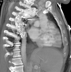 Graft in Aortic Arch - CTisus CT Scan