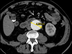 Abdominal Aortic Aneurysm (AAA) - CTisus CT Scan