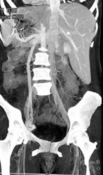 Prominent Gonadal Vein - CTisus CT Scan