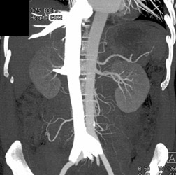 Reflux Into IVC in Carcinoid Syndrome - CTisus CT Scan