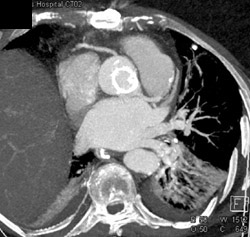 Post Bypass Graft - CTisus CT Scan