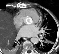 Stenosis in Coronary Artery - CTisus CT Scan