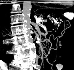 Marked Stenosis of SMA (MIP/VRT) - CTisus CT Scan