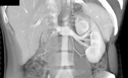 Normal Left Renal Vein - CTisus CT Scan