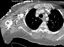 Near Occlusion of Innominate Vein - CTisus CT Scan