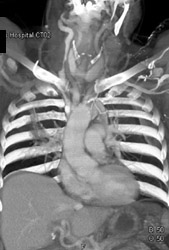 Stenosis of Right Carotid Artery - CTisus CT Scan