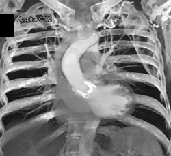 Aortic Valve Replacement - CTisus CT Scan