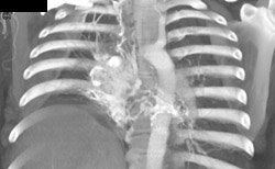 Collaterals in Right Hilum - CTisus CT Scan