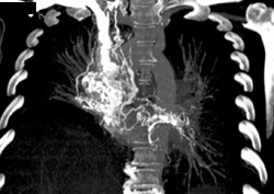 Collaterals in Hilum and Mediastinum - CTisus CT Scan